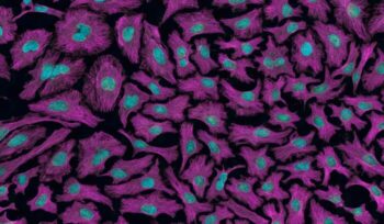 Cancer cells under microscope